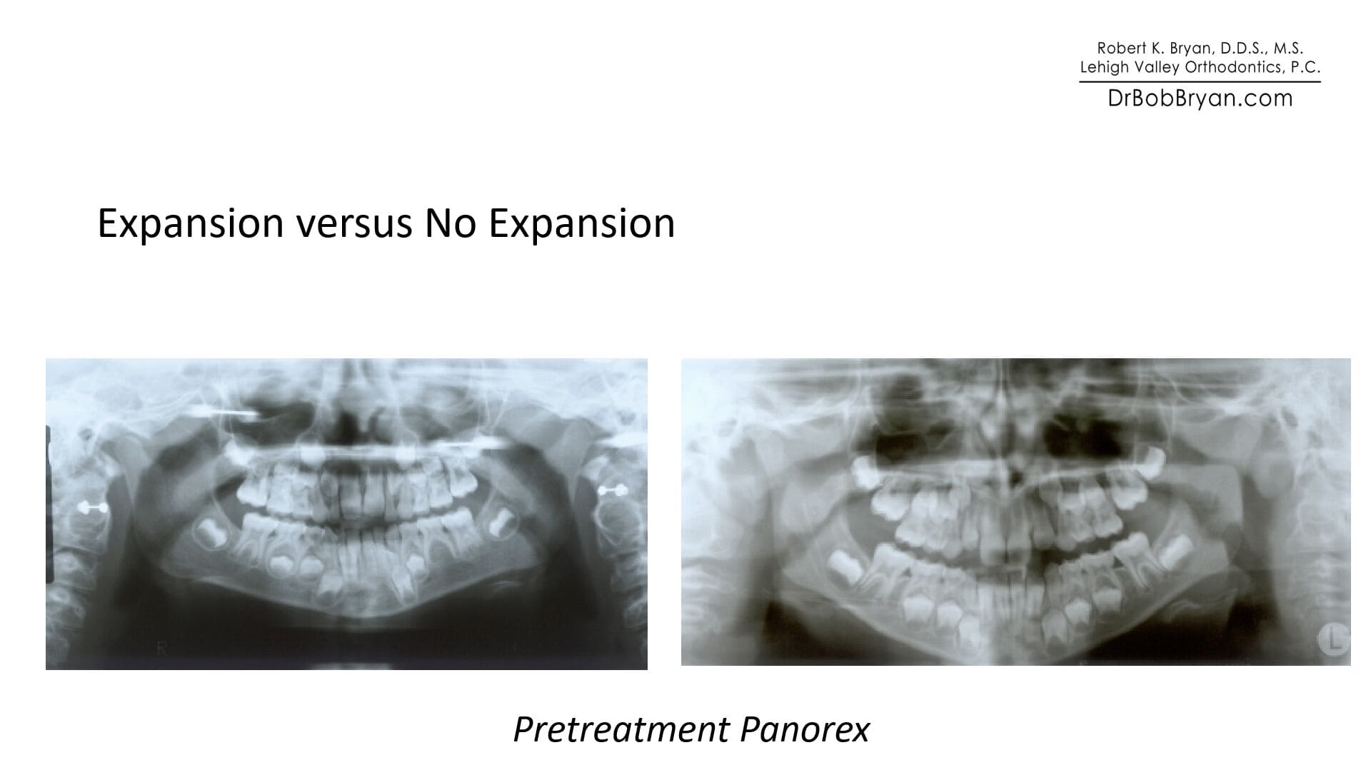 PRETREATMENT expansion vs no expansion