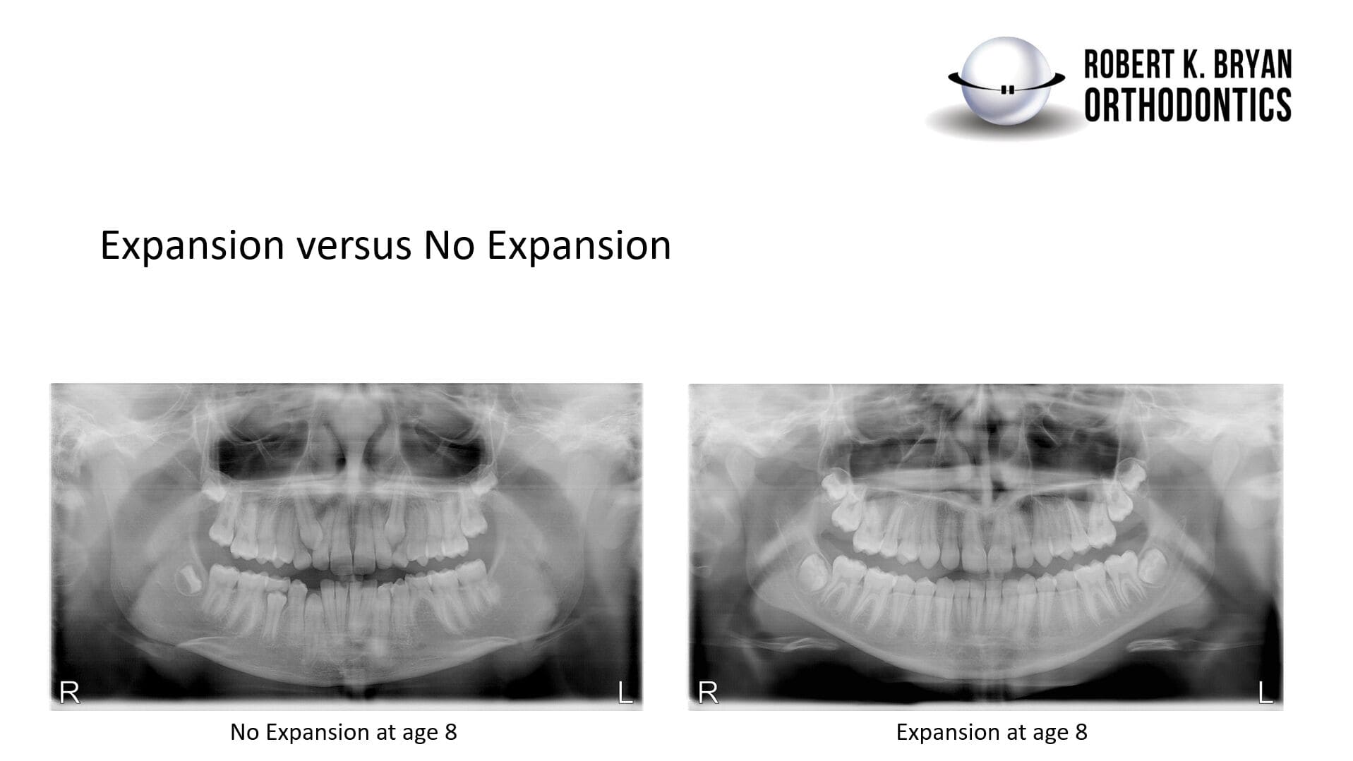post tx expansion vs no expansion